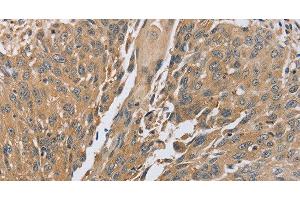 Immunohistochemistry of paraffin-embedded Human lung cancer using PTPN12 Polyclonal Antibody at dilution of 1:45 (PTPN12 抗体)