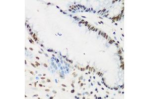 Immunohistochemistry of paraffin-embedded human stomach cancer using KLF4 antibody. (KLF4 抗体  (AA 180-479))