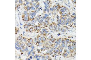 Immunohistochemistry of paraffin-embedded human liver cancer using MT-CYB antibody (ABIN7268595) at dilution of 1:100 (40x lens). (Cytochrome b 抗体)