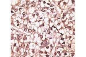 IHC analysis of FFPE human hepatocarcinoma tissue stained with the ABCB4 antibody (ABCB4 抗体  (AA 624-654))
