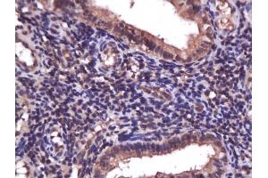 Formalin-fixed and paraffin embedded human endometrium carcinoma labeled with Anti-PI3K/PI3 kinase p85 alpha subunit Polyclonal Antibody, Unconjugated (ABIN725405) at 1:200 followed by conjugation to the secondary antibody and DAB staining. (PIK3R1 抗体  (AA 501-600))