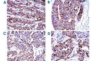 Immunohistochemical analysis of paraffin-embedded human cervical cancer (A) , human colon cancer (B) , human stomach cancer (C) and human bladder cancer (D) tissues using KRT19 monoclonal antibody, clone 4E8  with DAB staining. (Cytokeratin 19 抗体)