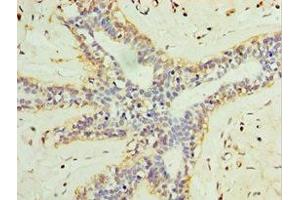 Immunohistochemistry of paraffin-embedded human breast cancer using ABIN7158005 at dilution of 1:100 (L3MBTL1 抗体  (AA 513-752))
