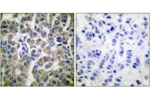 Immunohistochemistry analysis of paraffin-embedded human breast carcinoma tissue, using HSP10 Antibody. (HSPE1 抗体  (AA 51-100))