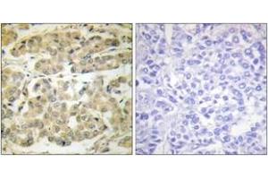 Immunohistochemistry analysis of paraffin-embedded human breast carcinoma, using 14-3-3 zeta (Phospho-Ser58) Antibody. (14-3-3 zeta 抗体  (pSer58))