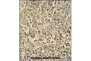 RNT2 antibody (N-term) (ABIN654720 and ABIN2844409) immunohistochemistry analysis in formalin fixed and paraffin embedded human spleen carcinoma followed by peroxidase conjugation of the secondary antibody and DAB staining. (RNASET2 抗体  (N-Term))