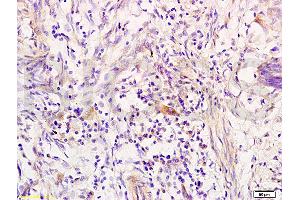 Formalin-fixed and paraffin embedded human colon carcinoma tissue labeled with Anti-RRM1 Polyclonal Antibody, Unconjugated (ABIN731543) at 1:200 followed by conjugation to the secondary antibody, (SP-0023), and DAB staining (RRM1 抗体  (AA 733-778))