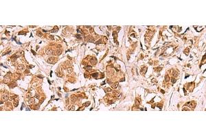 Immunohistochemistry of paraffin-embedded Human breast cancer tissue using RRP8 Polyclonal Antibody at dilution of 1:80(x200) (RRP8 抗体)