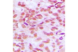 Immunohistochemical analysis of GSK3 alpha/beta staining in human breast cancer formalin fixed paraffin embedded tissue section. (GSK3 alpha/beta 抗体  (Center))