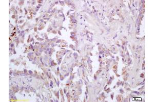 Formalin-fixed and paraffin embedded human lung carcinoma labeled with Rabbit Anti ChRM3/Acetylcholine receptor(M3) Polyclonal Antibody, Unconjugated (ABIN674484) at 1:200 followed by conjugation to the secondary antibody and DAB staining (CHRM3 抗体  (AA 481-589))