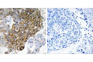 Peptide - +Immunohistochemistry analysis of paraffin-embedded human lung carcinoma tissue using GJA3 antibody. (GJA3 抗体  (Internal Region))