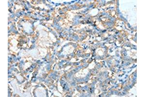 The image on the left is immunohistochemistry of paraffin-embedded Human thyroid cancer tissue using ABIN7128285(AGBL3 Antibody) at dilution 1/45, on the right is treated with fusion protein. (AGBL3 抗体)