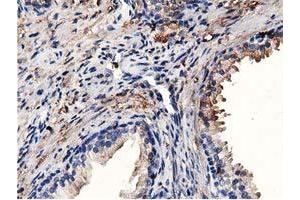 Immunohistochemical staining of paraffin-embedded Adenocarcinoma of Human colon tissue using anti-MICAL1 mouse monoclonal antibody. (MICAL1 抗体)