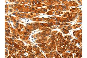 The image on the left is immunohistochemistry of paraffin-embedded Human liver cancer tissue using ABIN7191931(PLXNA3 Antibody) at dilution 1/25, on the right is treated with synthetic peptide. (Plexin A3 抗体)