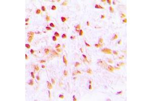 Immunohistochemical analysis of CDCA2 staining in human lung cancer formalin fixed paraffin embedded tissue section. (CDCA2 抗体  (Center))