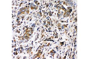 Anti-VRL1 antibody, IHC(P) IHC(P): Human Intestinal Cancer Tissue (TRPV2 抗体  (N-Term))
