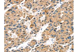 The image on the left is immunohistochemistry of paraffin-embedded Human liver cancer tissue using ABIN7192934(TRPV5 Antibody) at dilution 1/25, on the right is treated with synthetic peptide. (TRPV5 抗体)