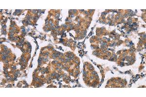 Immunohistochemistry of paraffin-embedded Human breast cancer tissue using ELP3 Polyclonal Antibody at dilution of 1:35 (ELP3/KAT9 抗体)