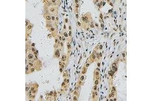 Immunohistochemical analysis of TBX1 staining in human lung cancer formalin fixed paraffin embedded tissue section. (T-Box 1 抗体  (C-Term))