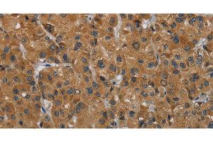 Immunohistochemistry of paraffin-embedded Human liver cancer using HSD3B7 Polyclonal Antibody at dilution of 1:40 (HSD3B7 抗体)