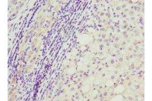Immunohistochemistry of paraffin-embedded human liver cancer using ABIN7162470 at dilution of 1:100 (TP53AIP1 抗体  (AA 1-108))