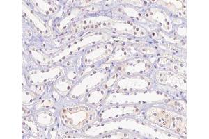 ABIN6267506 at 1/100 staining human kidney carcinoma tissue sections by IHC-P. (HNF4A 抗体  (pSer313))