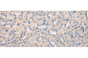 Immunohistochemistry of paraffin-embedded Human liver cancer tissue using DCAF7 Polyclonal Antibody at dilution of 1:30(x200) (DCAF7 抗体)