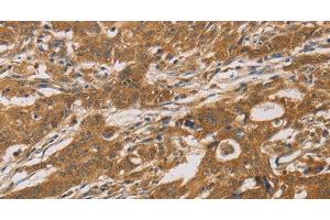 Immunohistochemistry of paraffin-embedded Human gastric cancer tissue using CYP17A1 Polyclonal Antibody at dilution 1:30 (CYP17A1 抗体)
