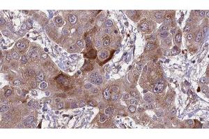 ABIN6276632 at 1/100 staining Human liver cancer tissue by IHC-P. (CD236/GYPC 抗体  (Internal Region))