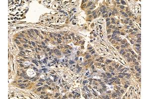 DYRK3 Mouse Monoclonal Antibody at 1/100 staining human lung cancer and adjacent non-tumor tissue by IHC-P.