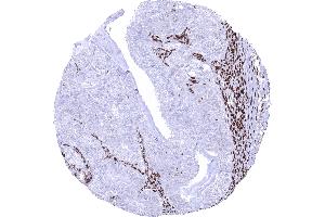 Ovary Malignant Mixed Mullerian tumor with strong MSH2 positivity in stromal and inflammatory cells but absence of staining in tumor cells (Recombinant MSH2 抗体)
