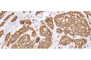 Immunohistochemistry of paraffin-embedded Human esophagus cancer tissue using E2F5 Polyclonal Antibody at dilution of 1:25(x200) (E2F5 抗体)