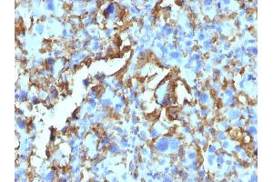 Formalin-fixed, paraffin-embedded human Histiocytoma stained with HLA-DR Monoclonal Antibody (LN-3 + HLA-DRB/1067). (HLA-DRB1 抗体)