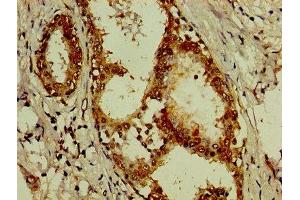 IHC image of ABIN7143827 diluted at 1:200 and staining in paraffin-embedded human breast cancer performed on a Leica BondTM system. (alpha Actinin 4 抗体  (AA 160-440))