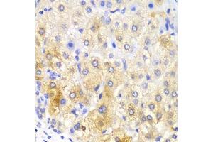 Immunohistochemistry of paraffin-embedded human liver cancer using FASN Antibody. (Fatty Acid Synthase 抗体  (AA 2212-2511))