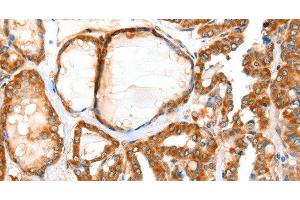 Immunohistochemistry of paraffin-embedded Human thyroid cancer tissue using ACOX1 Polyclonal Antibody at dilution 1:40 (ACOX1 抗体)