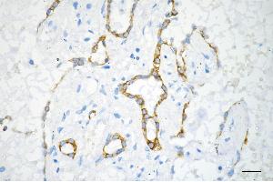Immunohistochemistry was performed on paraffin-embedded human lung adenocarcinoma using EGFR antibody (ABIN7798480), 1:200). (Recombinant EGFR 抗体)