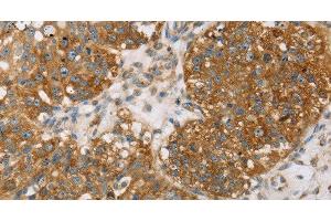 Immunohistochemistry of paraffin-embedded Human breast cancer using TPD54 Polyclonal Antibody at dilution of 1:35 (TPD52L2 抗体)