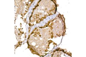 Immunohistochemistry (IHC) image for anti-Cancer/testis Antigen 1B (CTAG1B) (AA 1-180) antibody (ABIN6139172)