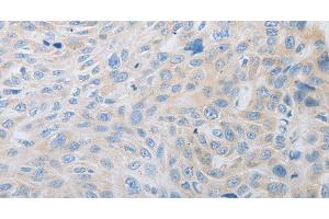 Immunohistochemistry of paraffin-embedded Human esophagus cancer using PDX1 Polyclonal Antibody at dilution of 1:30 (PDX1 抗体)