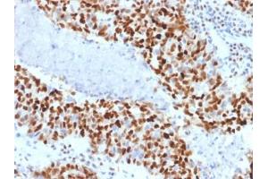 ABIN6383795 to Cyclin E1 was successfully used to stain nuclei in human colon carcinoma sections. (Cyclin E1 抗体  (AA 10-176))