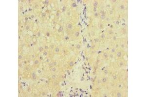 Immunohistochemistry of paraffin-embedded human liver cancer using ABIN7167234 at dilution of 1:100 (RAB18 抗体  (AA 1-206))