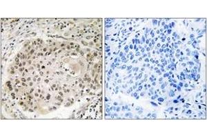 Immunohistochemistry analysis of paraffin-embedded human lung carcinoma, using USP36 Antibody. (USP36 抗体  (AA 501-550))