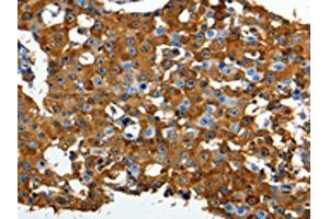 The image on the left is immunohistochemistry of paraffin-embedded Human breast cancer tissue using ABIN7191316(LRP1 Antibody) at dilution 1/90, on the right is treated with synthetic peptide. (LRP1 抗体)