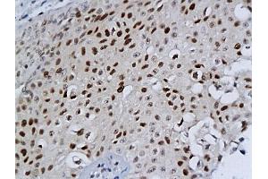Formalin-fixed and paraffin embedded bladder cancer labeled with Anti-MCM-2 Polyclonal Antibody, Unconjugated (ABIN676238) at 1:200 followed by conjugation to the secondary antibody and DAB staining (MCM2 抗体  (AA 601-700))