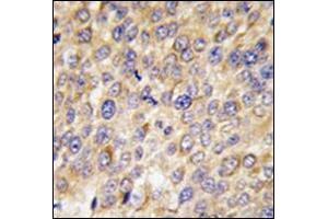 Formalin-Fixed, Paraffin-Embedded human hepatocarcinoma tissue reacted with Autophagy GABARAP Antibody (N-term) followed which was peroxidase-conjugated to the secondary antibody, followed by DAB staining. (GABARAP 抗体  (N-Term))