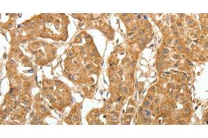 Immunohistochemistry of paraffin-embedded Human lung cancer tissue using MAP1B Polyclonal Antibody at dilution 1:60 (MAP1B 抗体)