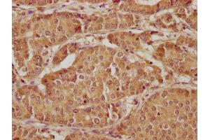 IHC image of ABIN7157400 diluted at 1:300 and staining in paraffin-embedded human gastric cancer performed on a Leica BondTM system. (Keratin 2 抗体  (AA 207-424))