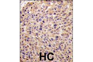 Formalin-fixed and paraffin-embedded human hepatocarcinoma tissue reacted with GGPS1 Antibody (N-term), which was peroxidase-conjugated to the secondary antibody, followed by DAB staining. (GGPS1 抗体  (N-Term))