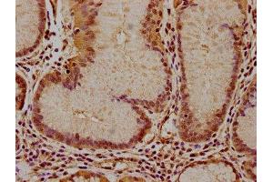 IHC image of ABIN7156557 diluted at 1:100 and staining in paraffin-embedded human gastric cancer performed on a Leica BondTM system. (IFNA16 抗体  (AA 24-189))